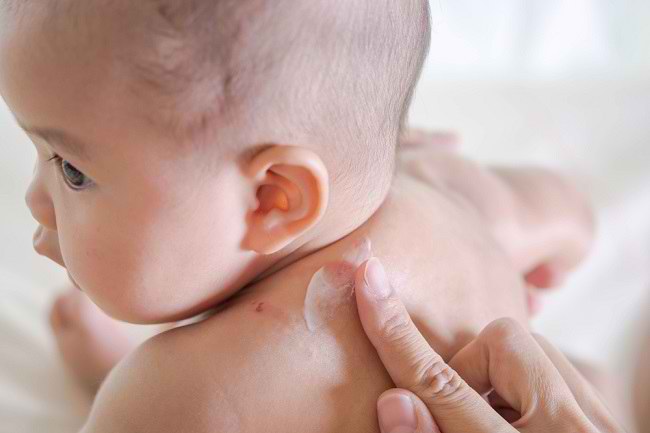 赤ちゃんの肌の赤い斑点の原因とその取り扱いを認識する