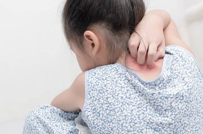أعراض وعلاج الجرب عند الأطفال