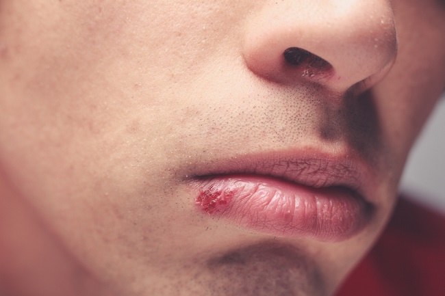 Mengenali Herpes di Bibir dan Mulut dan Cara Mengatasinya