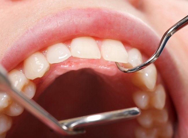 簡単で実用的、これらは歯のプラークを取り除く5つの方法です