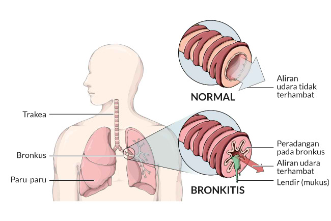 Bronkitis disebabkan oleh