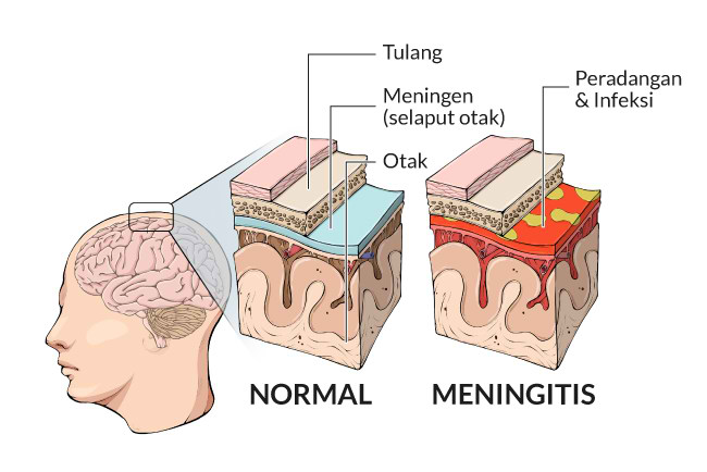 Apa itu Meningitis?