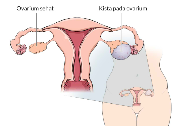 卵巣嚢胞とは何ですか？