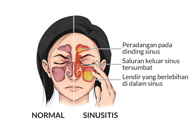 Definisi Sinusitis
