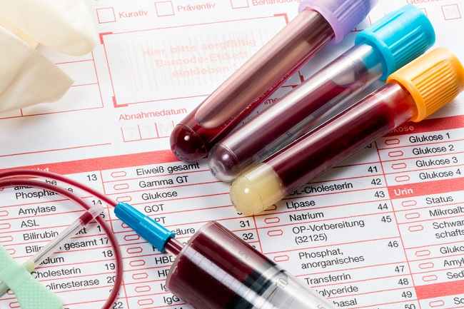 Diyabeti Tespit Etmek ve Kontrol Etmek İçin HbA1c Testi