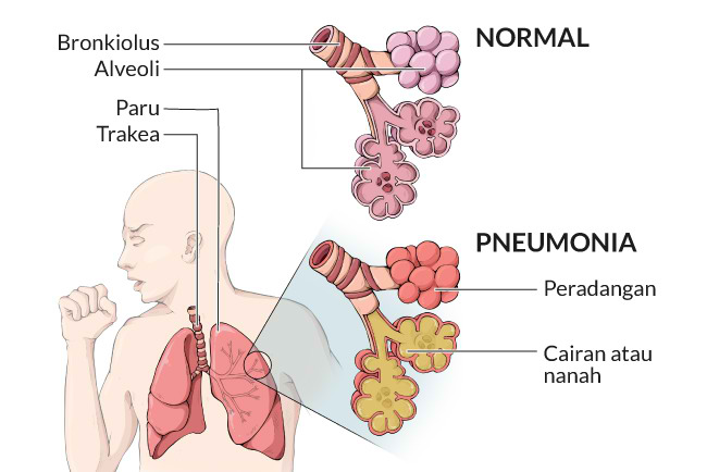 Definisi Pneumonia